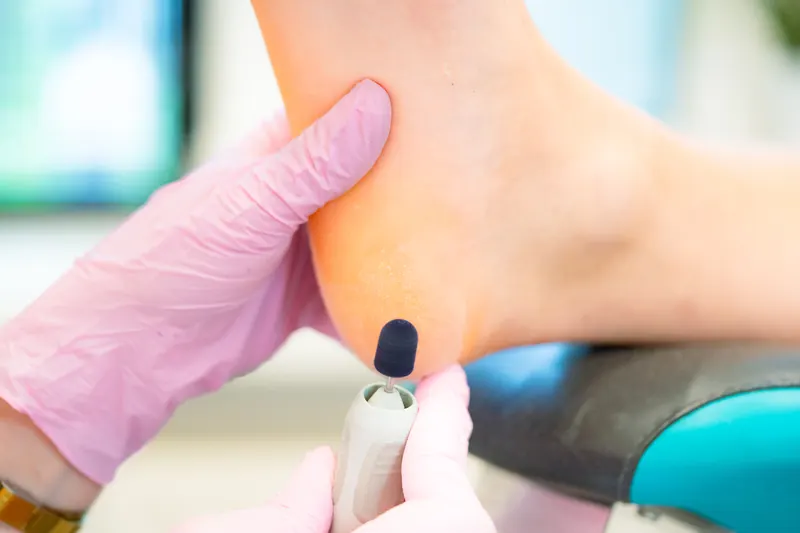 Schrunden am Fuß behandeln – Risiken der Behandlung in der Praxis PodoTrend