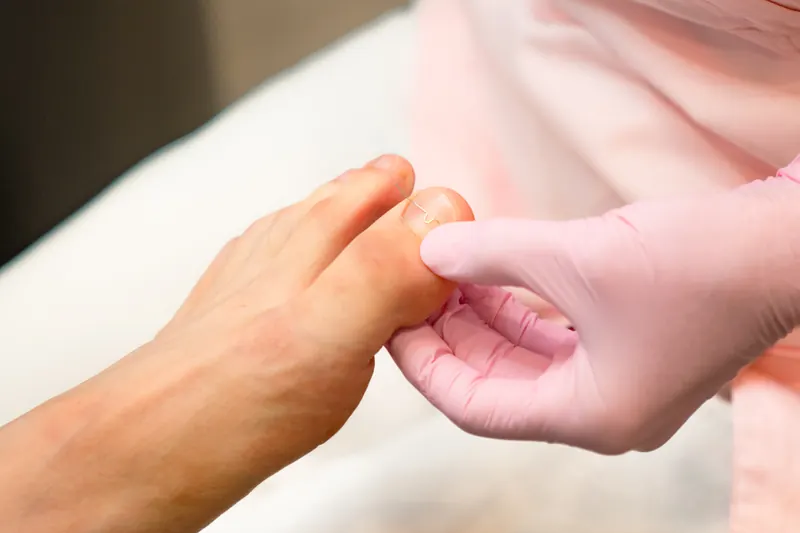 Trockene Füße behandeln – Risiken der Behandlung in der Praxis PodoTrend